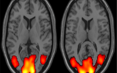اف ام آر آی (fMRI) یا ام آر آی عملکردی یا فانکشنال چیست؟